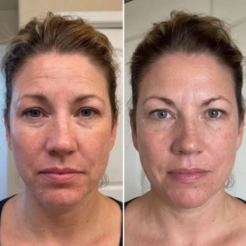 Velau™ Rent Collagen Stift